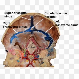 Internal View Of The Case Presented Herein - Superior Sagittal Sinus Cadaver, HD Png Download