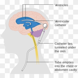 Diagram Showing A Brain Shunt Cruk - Ventriculosubgaleal Shunt, HD Png Download