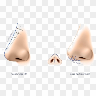 Nose Png Image - Nose Filler Vs Nose Thread Lift, Transparent Png