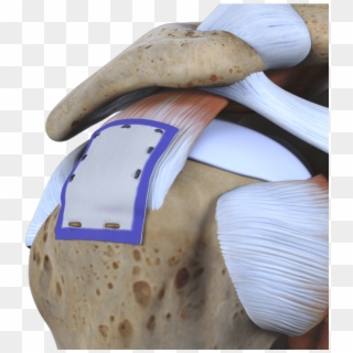 Study Points To Rotator Cuff Healing And No Tear Progression - Biological Patch Rotator Cuff, HD Png Download
