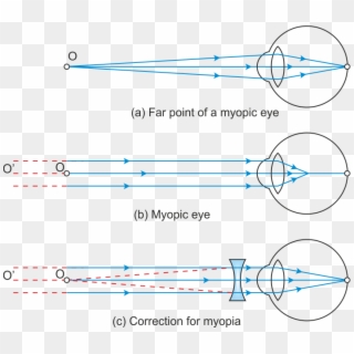 Hypermetropia Or Far Sightedness - Far Point And Near Point Of Myopic Eye, HD Png Download