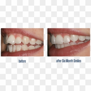 Smile Teeth Png - Before And After Six Month Smile, Transparent Png