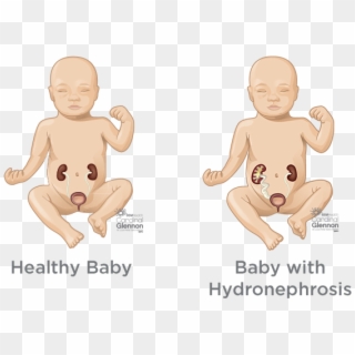 If Your Baby Has Restricted Urine Flow Or Urine Reflux, - Hydronephrosis In Infants, HD Png Download