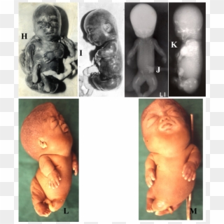 (r) Showing Lethal Skeletal Dysplasia - Baby, HD Png Download