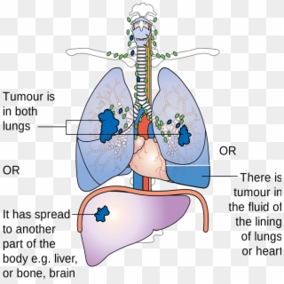 Negative Effects Of Smoking - Tnm Staging Pancoast Tumor, HD Png Download