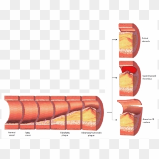 Late Complications Of Atherosclerosis, HD Png Download