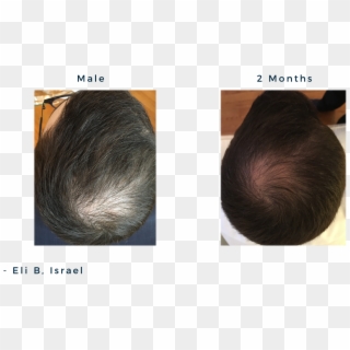 Male 20y, Androgenic Alopecia / Male Patterned Balding, HD Png Download