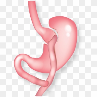 Illustration Of Gastric Bypass - Balloon, HD Png Download