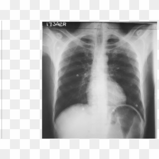 Cxr Pa Showing Distended Stomach - X-ray, HD Png Download