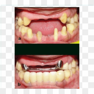 Pre Rehabilitation View And (b) Intraoral View Post - Tongue, HD Png Download