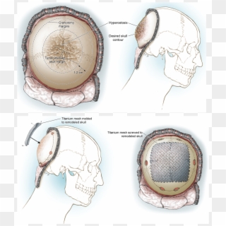 Illustrations Of The In Situ Cranioplasty Method - Circle, HD Png Download