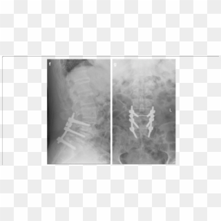 F, G Postoperative Lumbar Spine Showing L4-l5 Correction - X-ray, HD Png Download