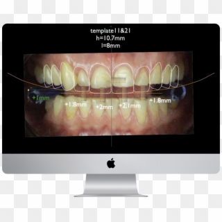 Teaser Digital Smile Design - Computer Monitor, HD Png Download