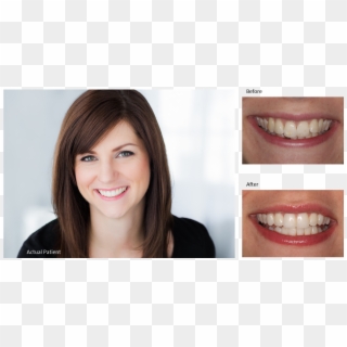 Teeth Straightening With Invisalign - Girl, HD Png Download