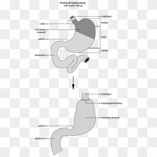 The Gastrointestinal Tract Is Then Reconstructed By - Proximal Gastrectomy, HD Png Download