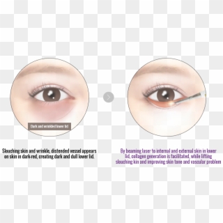Some People May Notice Dark Under Eye Circles Moving - Eyelash Extensions, HD Png Download
