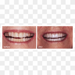 Shot Of Before And After Visiting Abington Smile Gallery - Aggression, HD Png Download
