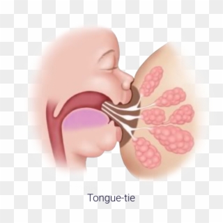Infant Tongue Tie Treatment - Tongue Tie, HD Png Download