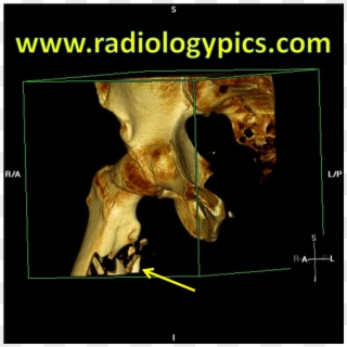 Subtrochanteric Femur Fracture - Atlanta, HD Png Download