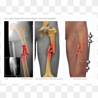 Left Femur Fracture And External Fixator Placement - Bone, HD Png Download