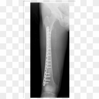 Postoperative Radiography After The Femur Reconstruction - X-ray, HD Png Download