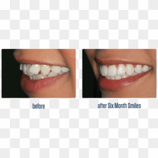 Six Month Smile Gallery1, HD Png Download
