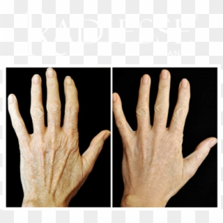 Before And After Treatment With Radiesse® Hands - Radiesse Hands, HD Png Download