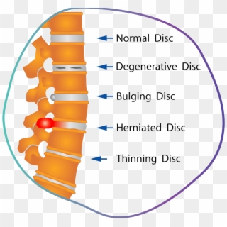 Discs-damaged - Herniated Discs, HD Png Download