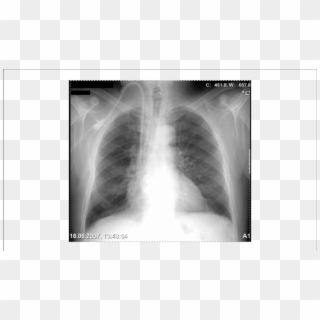 Chest X-ray Of A Patient With A Tunnelled Right Internal - Right Internal Jugular Catheter, HD Png Download
