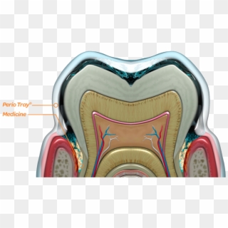 The Perio Tray® Delivers Medicine Into The Periodontal - Hearing, HD Png Download