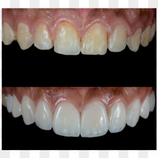 Before And After Of White Teeth - Стоматологические Виниры, HD Png Download