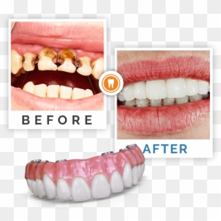 Before And After Dental Procedure - Rotte Tanden Kinderen, HD Png Download