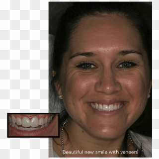 Chipped Front Teeth After Porcelain Veneers Treatments - Girl, HD Png Download