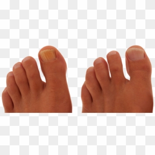 Before After Feet - Toe, HD Png Download