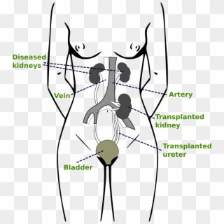 Kidney Transplantation Pdf , Png Download - Transplantable Organs, Transparent Png