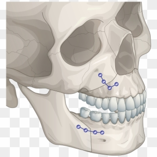 Two-jaw Surgery - Orthognathic Surgery, HD Png Download
