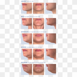 Take A Look At The Photos Below* And Select The Image - Double Chin Stages, HD Png Download