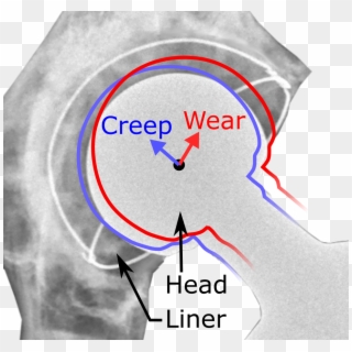 Hip Prosthesis Liner Creep And Wear - Hip Arthroplasty Creep, HD Png Download