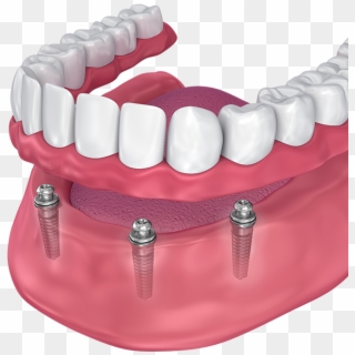Implant-supported Dentures - Implant Supported Overdenture, HD Png Download