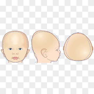 Cranial Head Shapes - Brachycephaly Forehead, HD Png Download