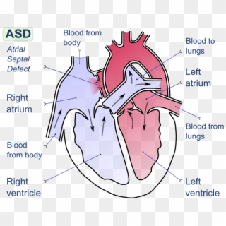 Atrial Septal Defect-en - Atrial Septal Defect, HD Png Download ...