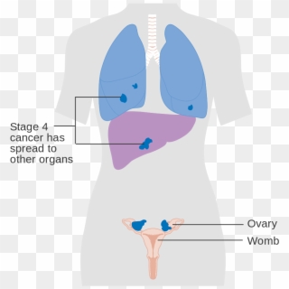 Diagram Showing Stage 4 Ovarian Cancer Cruk - Stage 4 Ovarian Cancer Criteria, HD Png Download