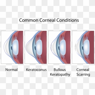 Click To Enlarge - Abnormal Shape Of The Cornea Or Lens, HD Png Download