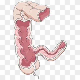 Similar - Crohn's Disease Png, Transparent Png