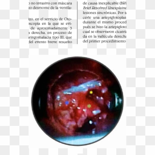 Lesión En La Vallécula Derecha , Epiglotis (asterisco - Crystal, HD Png Download
