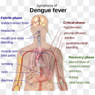 1000px-dengue Fever Symptoms - Dengue Retro Orbital Pain, HD Png Download