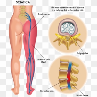 What Causes Sciatic Nerve - Sciatica Pain, HD Png Download