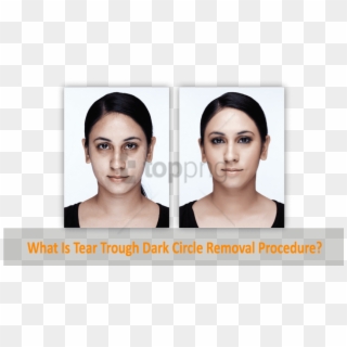 Dark Circle Eye Roller Before And After Png Image With - Dermisa Brightening Cream Before, Transparent Png
