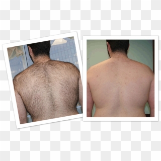 Male Back Laser Hair Removal Before And After - Sprej Na Odstránenie Chĺpkov, HD Png Download