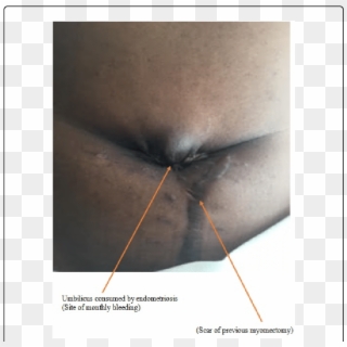 Scar Of Previous Myomectomy And Navel Where Menstrual - Menstrual Bleeding, HD Png Download